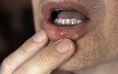 ¿Por qué tengo aftas en verano?