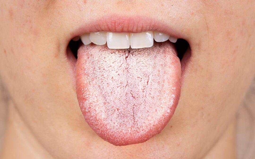 Candiadisis oral
