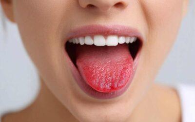 Liquen plano oral: síntomas, diagnóstico y tratamiento en Klinika B2 Vitoria-Gasteiz