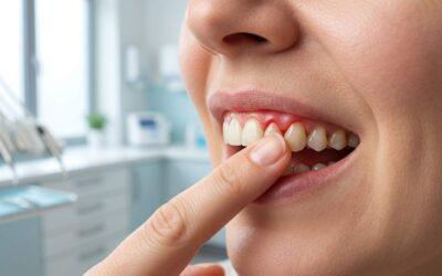 Qué significa que sangren las encías