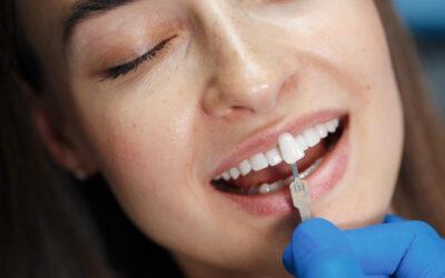 Blanqueamiento dental en Vitoria: cuándo funciona y qué debes saber antes
