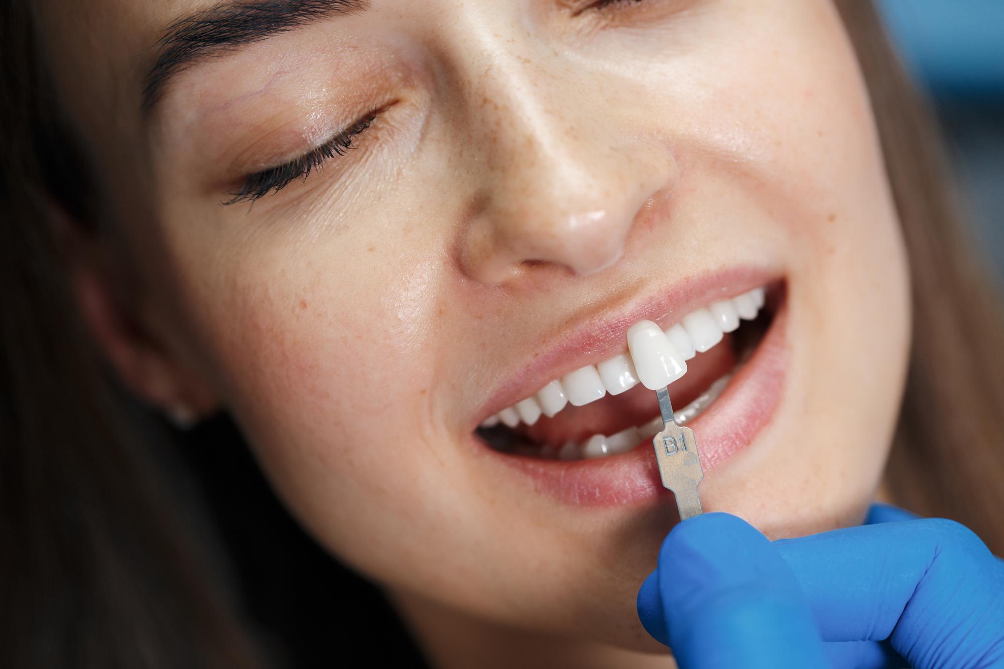 Blanqueamiento dental en Vitoria — Klinika B2 clínica dental